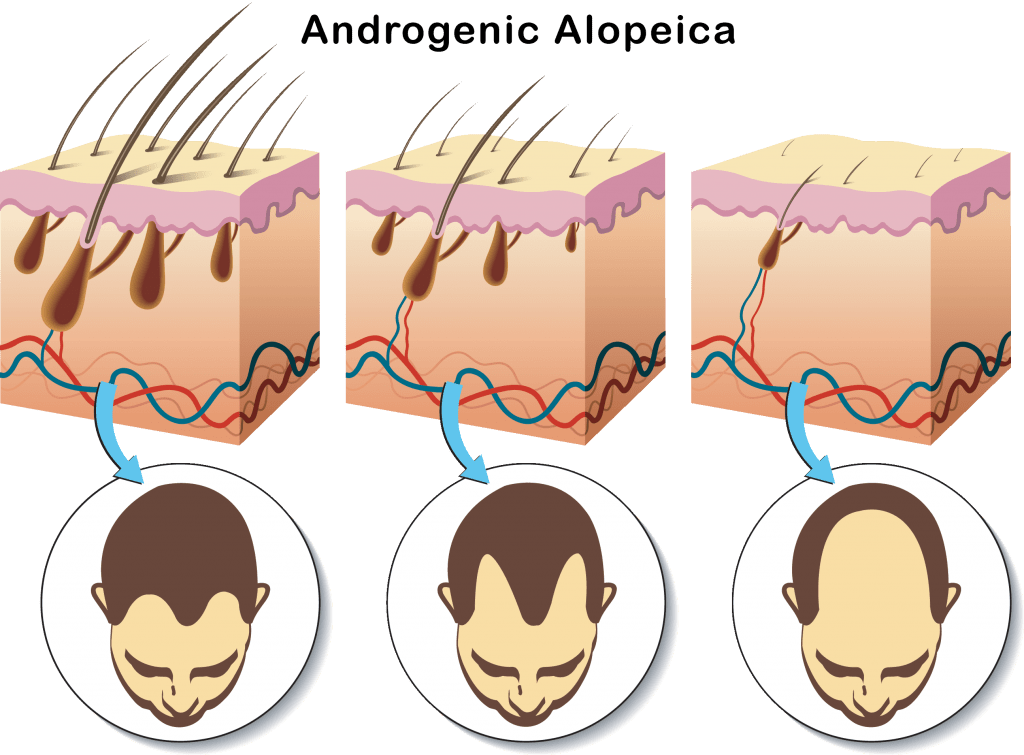 This graphic shows the process of miniaturization over time due to androgenic alopecia. Sensitive androgen receptors attract DHT molecules from the bloodstream, which then attach the receptors on the hair follicles. Eugenol’s effect on androgen receptor activity has been researched, although not always in relation to hair loss -- which is why it is important to critically appraise this literature before deciding to use eugenol for hair strength.