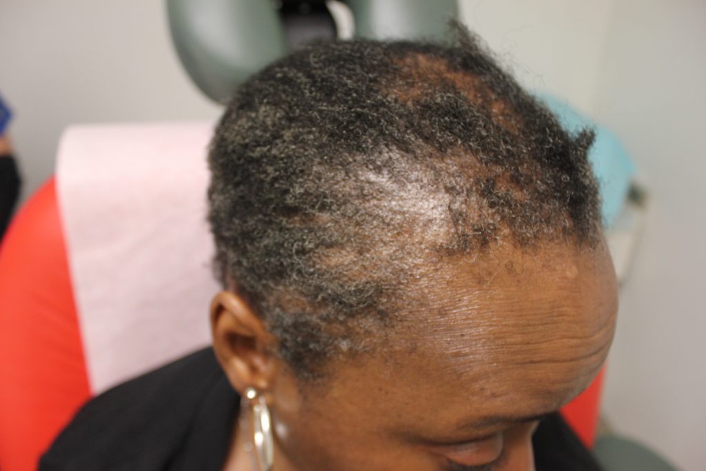 Before Dr.UGro Natural Hair Pomade, Diane's Hair on her edges and temples were short, lacking in volume and fullness and breaking