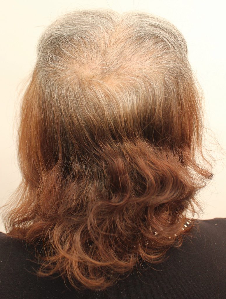 Although her hair did grow back months after chemotherapy, the texture and tone of the hair changed. Her hair had lost its luster and it was breaking