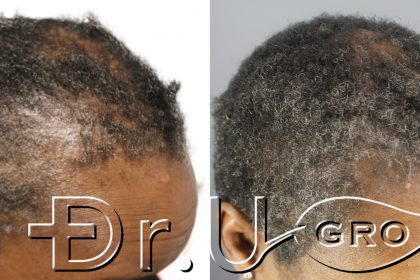 Within 3 months of starting Dr.UGro Gashee Diane’s hair health had been restored in her edges* Within 3 months of starting Dr.UGro Gashee Diane’s hair health had been restored in her edges*
