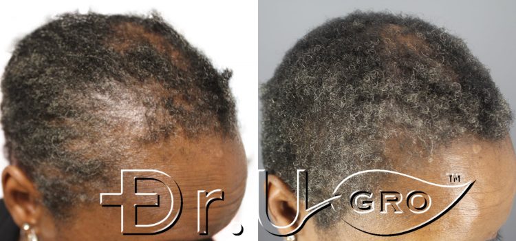 Within 3 months of starting Dr.UGro Gashee Diane’s hair health had been restored in her edges*