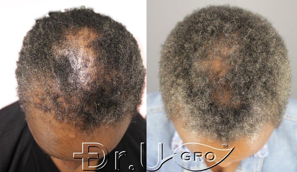 Within 3 months of starting Dr.UGro Gashee Diane's hair health was returning 