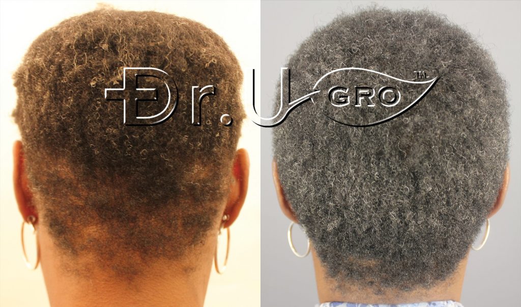 Within 3 months of starting Dr.UGro Gashee Diane's hair was fuller and longer all over