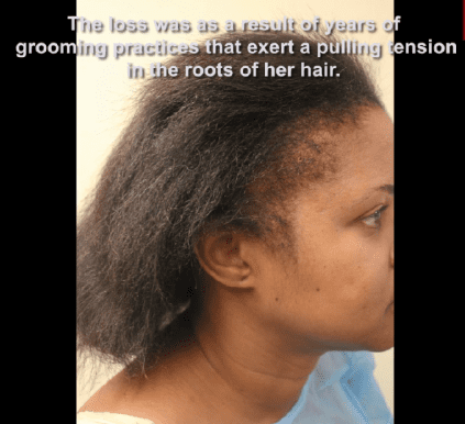 Years of risky, tightly-pulling hairstyling practices led to depleted edges in this Traction Alopecia sufferer 