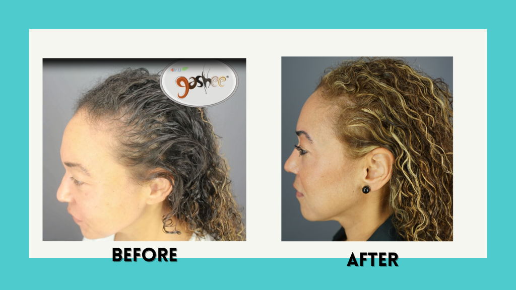 Before & After 11 Months Post Treatment Results Dr.UGRO GASHEE Natural Hair Care Products for Hair Loss infused with Vitamin B5.