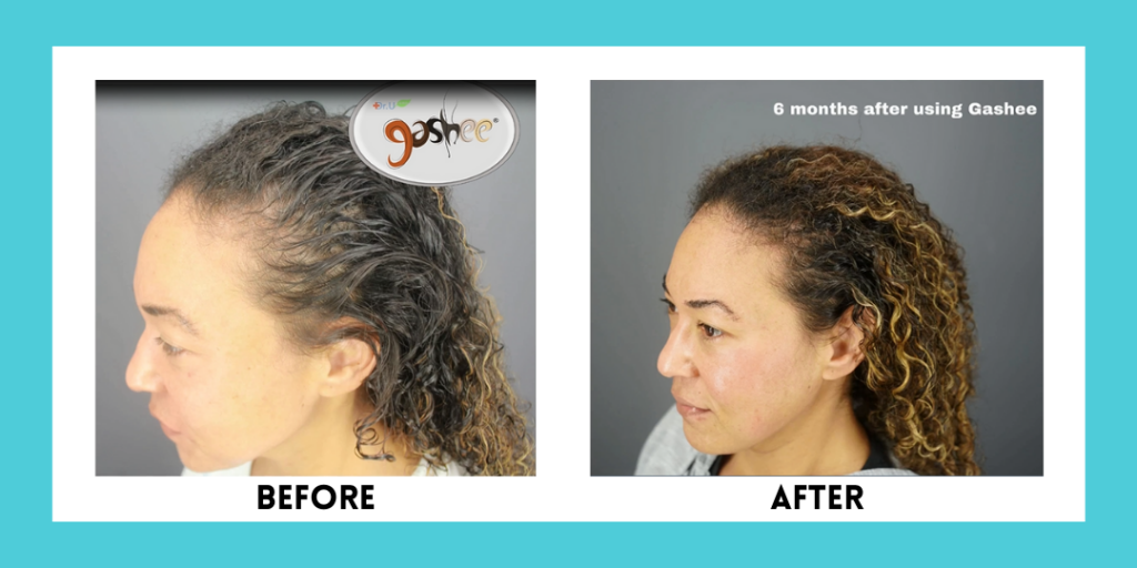 Before & After 8 Months Post Treatment Results JS Dr.UGRO GASHEE Natural Hair Care Products for Improved Hair Health.