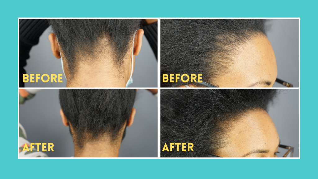 Before and after results: Gashee Natural Hair Growth Products.