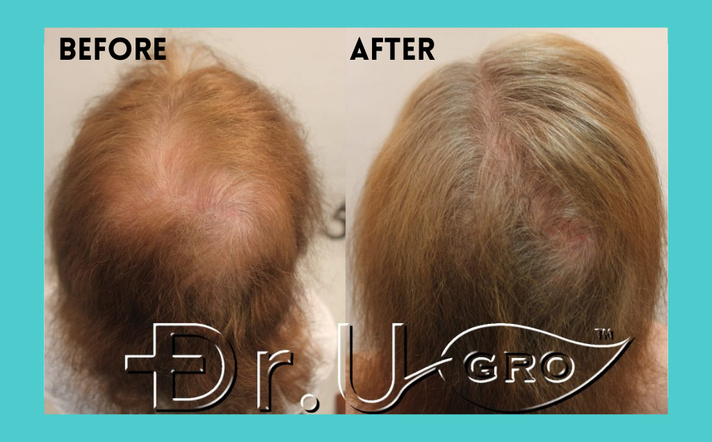 Before and After Results Dr.UGRO GASHEE Topicals for Hair Growth, Published Study Results. Note the change in hair density, thickness, and volume after only 3 months of treatment. Infused with Olive Leaf Extract.