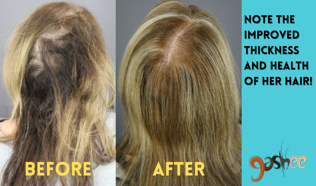 Bernadette Before and After V1: Dr. UGro Gashee Oral Hair Supplements, Infused with Vitamin E to help restore and fortify hair health.