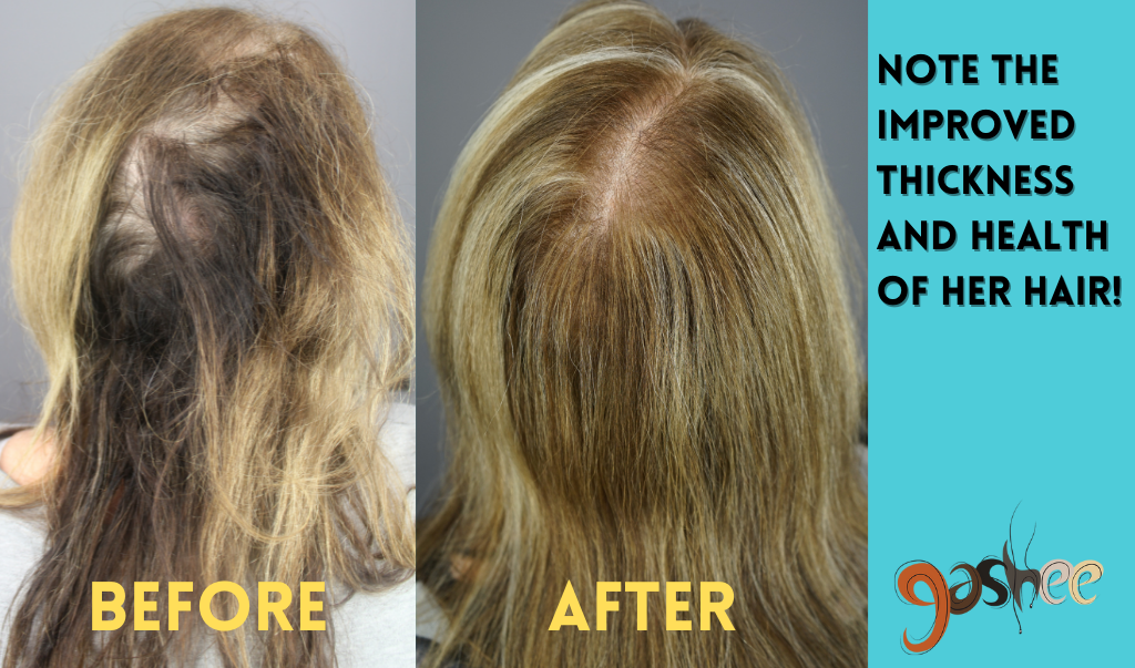 Bernadette Before and After V1: Dr. UGro Gashee Oral Hair Supplements.