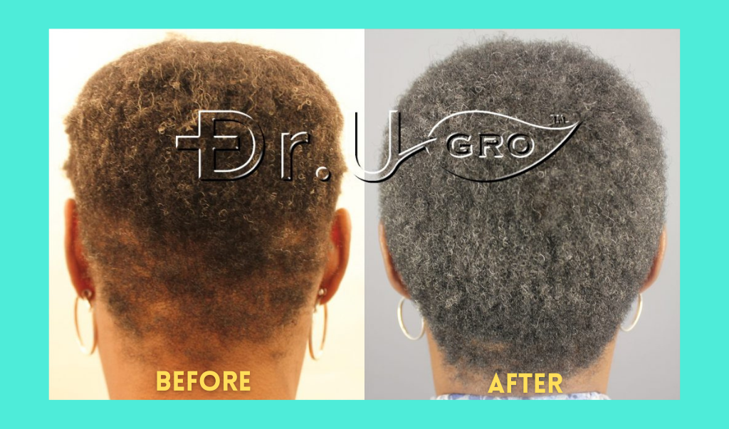 Diane before and after several months using Lecithin containing topical pomade Gashee*
