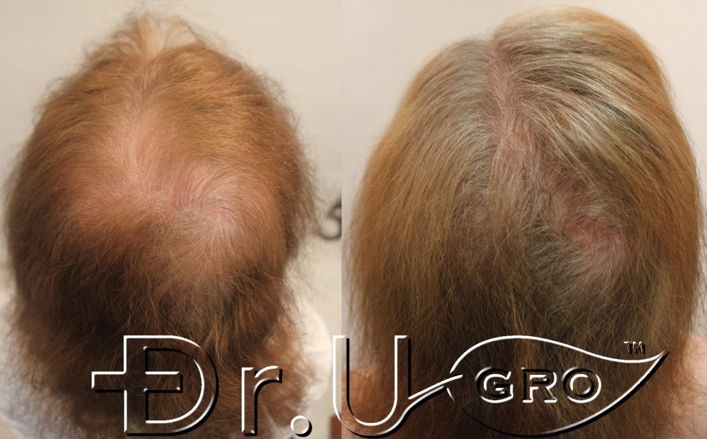 Dr. UGro Gashee all-natural hair growth results: before on the left and after on the right.