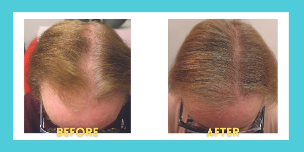 Hair improvements results: Before and After several months using Syringa Oblata-containing topical pomade Gashee*