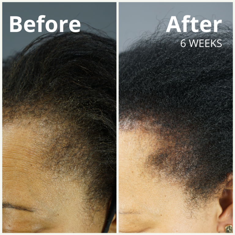 Before and After - Natural Hair Health Results with Dr.UGro GASHEE Botanical Hair Products for Improved Hair Health - Afro Textured Hair Results.*