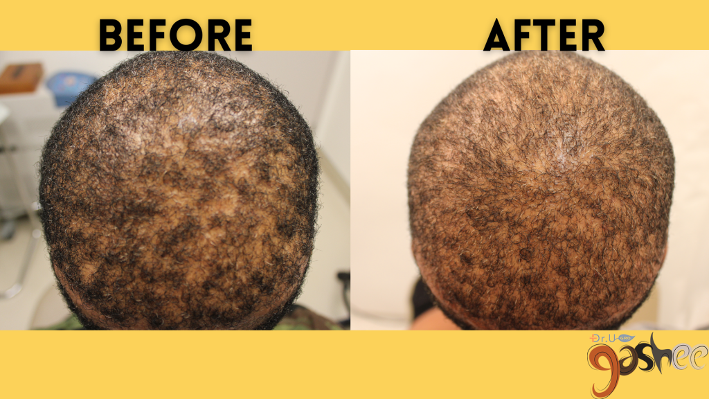 Before and After Picture Results of Dr.UGRO GASHEE Natural Hair Topical Lotion after 5 months of daily use. Notice the filling out of bald spots and patchy scalp hair, as well as his overall improved hair health results.*