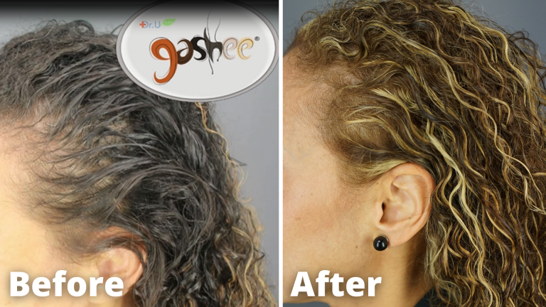 Before and After Picture Results of Dr.UGro GASHEE Hair Growth Products - Topical Lotion & Oral Hair Supplement.