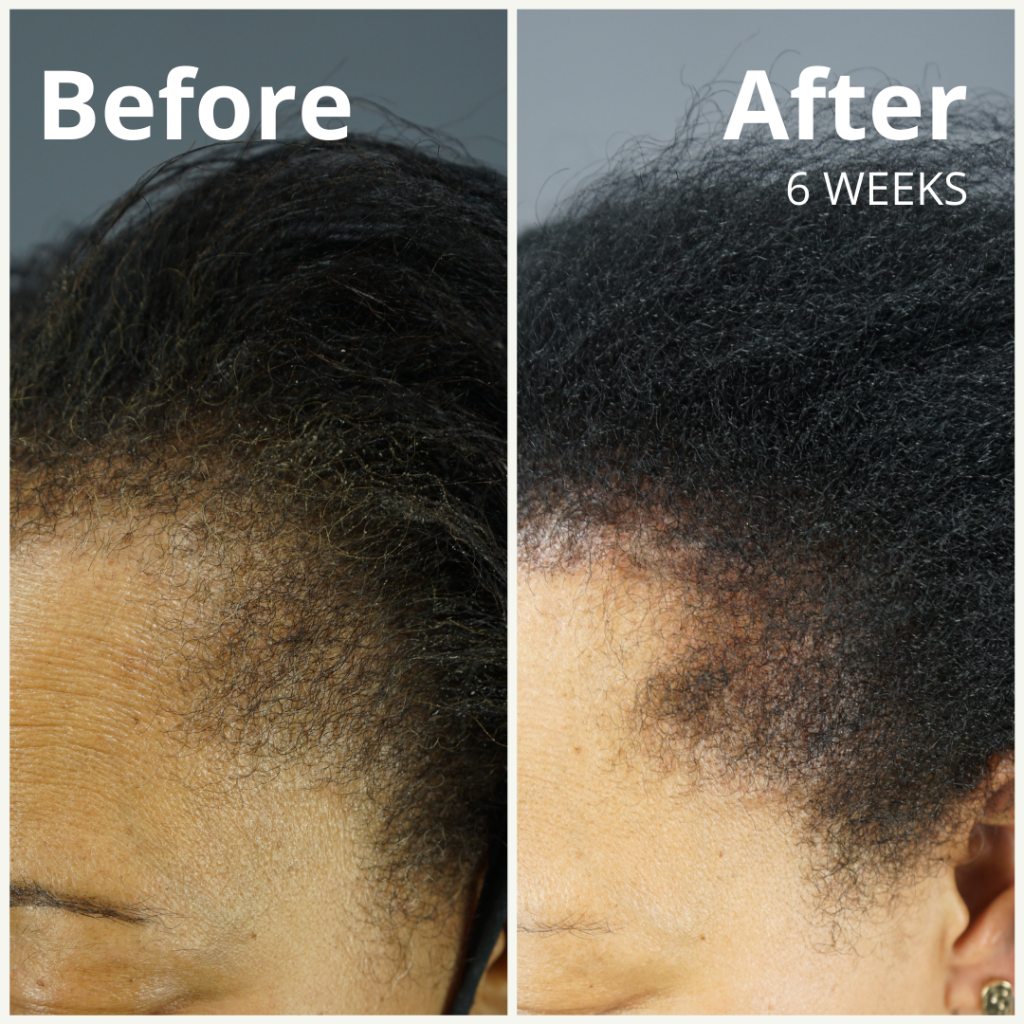 GASHEE 6 Weeks Before and After Hair Health Improvement Results. Notice the thickening and added hair density of her edges.*