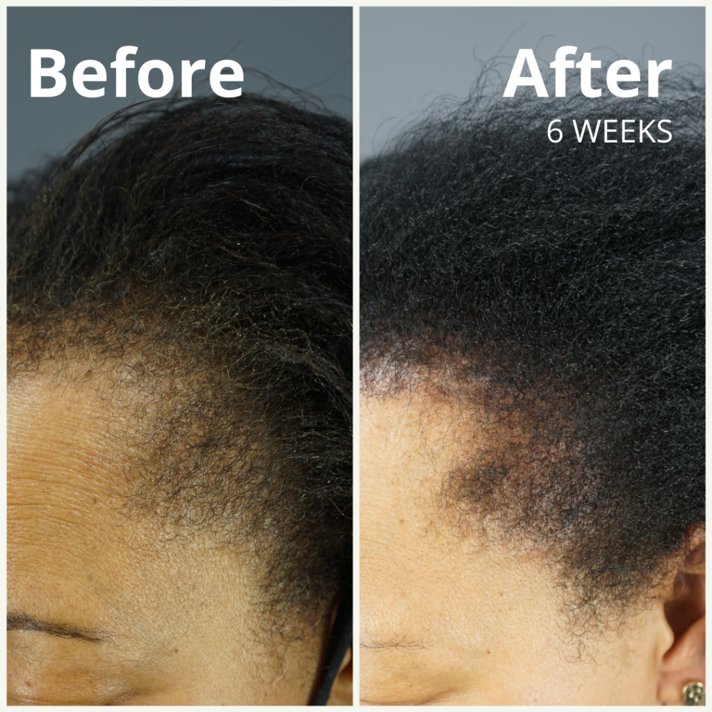 GASHEE Hair Stories: 6 Weeks to Better Edges With Natural Growth - Dr ...