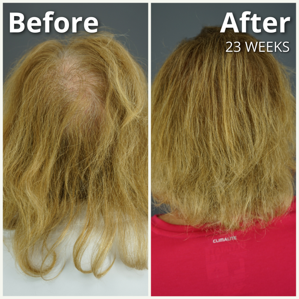 Dr.UGro Gashee Natural Topical Lotion Before and After Hair Growth Results - after 23 weeks of daily use. Note the improved hair health, hair density, and hair volume and length.