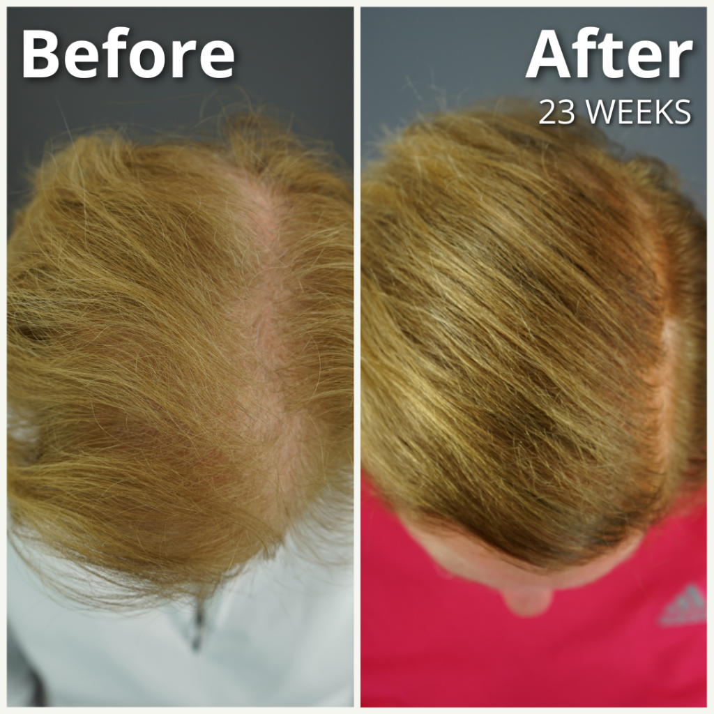 Dr.UGro Gashee Natural Topical Lotion Before and After Hair Growth Results - after 23 weeks of daily use. Note the improved hair health, hair density, and hair volume and length.