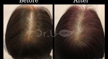 GASHEE Hair Stories: Doctor-Approved Hair Growth Results