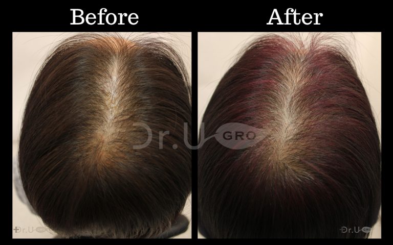 Dr.UGro GASHEE Natural Hair Health Improvement Results with Dark Hair Using Natural Botanical Topical Lotion for Hair Health. Notice the increased hair thickness, volume, and density over 3 months' time.*