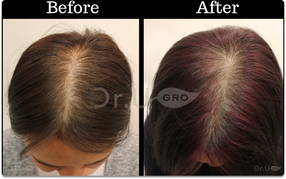 Dr.UGro GASHEE Natural Hair Growth Results with Dark Hair Using Natural Botanical Topical Lotion and Oral Hair Supplement for Hair Health. Through this angle, this doctor's new and improved hair length can be seen. Notice the new length, volume, and hair density she was able to acquire