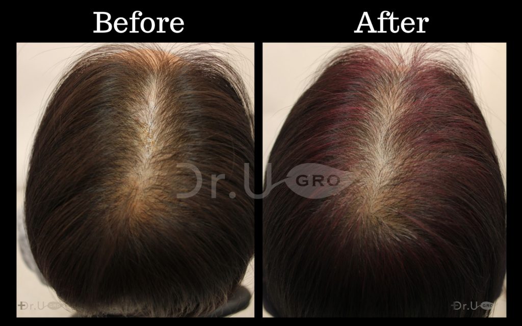 Dr.UGro GASHEE Natural Hair Growth Results with Dark Hair Using Natural Botanical Topical Lotion for Hair Health and Oral Hair Supplements. Notice the increased hair thickness, volume, and density.