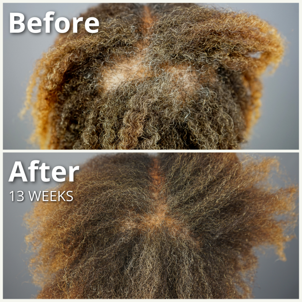 Dr.UGro GASHEE User Before and After Topical Lotion Hair Health. 13 Weeks after using GASHEE Natural Hair Lotion twice a day.*
