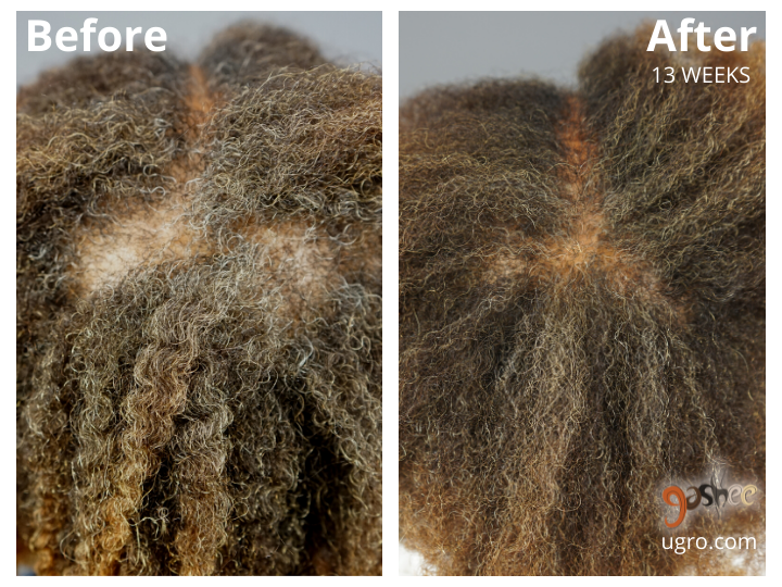 Dr.UGro Gashee DC Before and After Topical Lotion Results for Hair Growth, Hair Health.