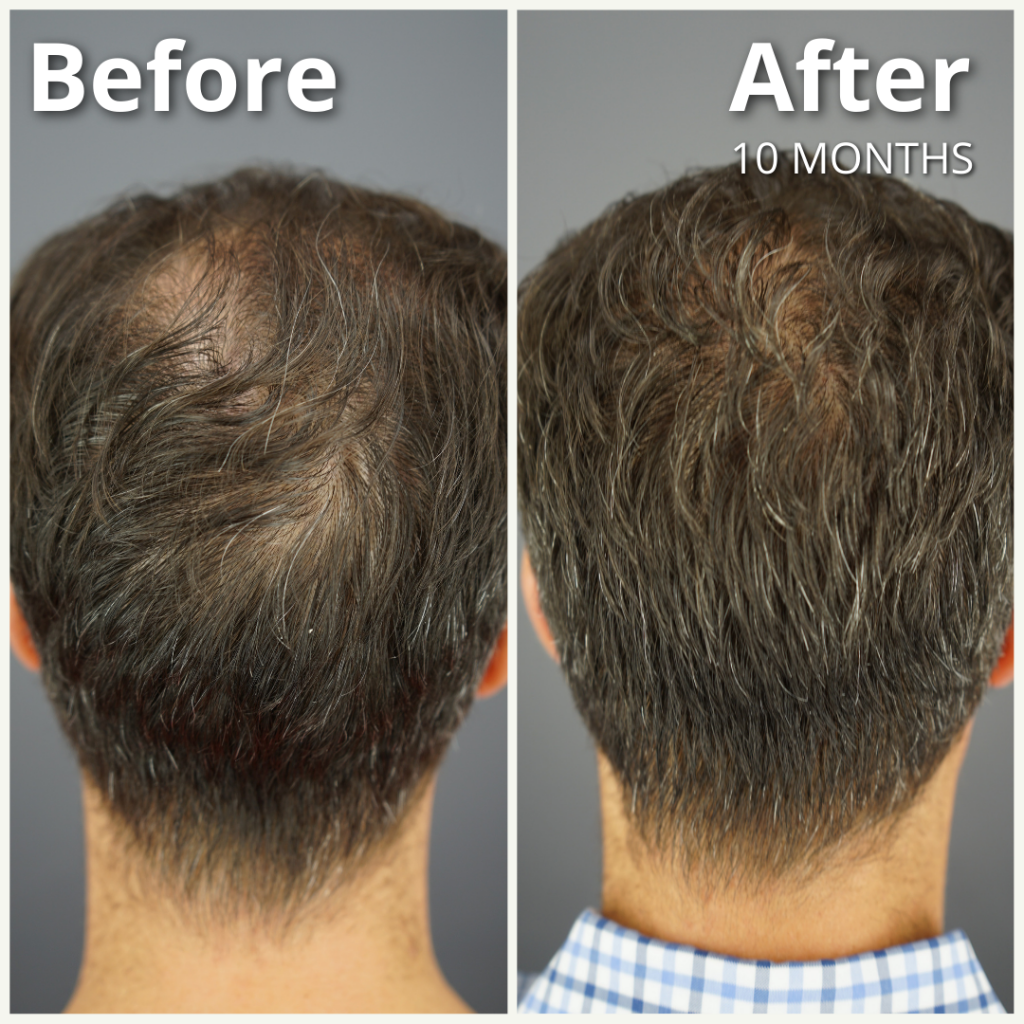 Dr.UGro GASHEE Topical Lotion Before and After Natural Hair Health Results. The patient had suffered from male pattern baldness and reported hair thinning before using GASHEE. He applied GASHEE Lotion on his scalp twice a day. Note the difference in hair thickness, hair texture, and hair density and volume in the after picture to the right after 10 months of use.*