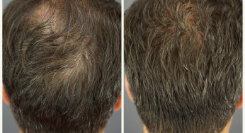 GASHEE Hair Stories: Stop Men’s Hair Loss with GASHEE