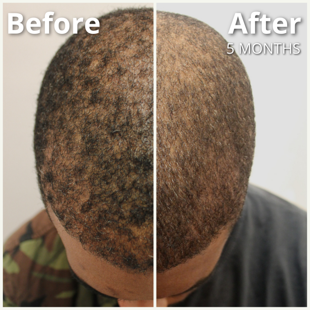 Dr.UGro GASHEE Before and After Results Topical Natural Hair Lotion - Hair Improvement Results after 5 months of GASHEE Natural Hair Lotion.*