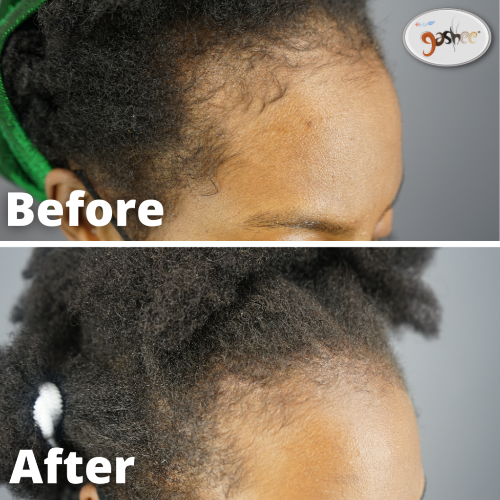 Before & After GASHEE Natural Hair Oral Supplements & Topical Lotion for Hair Health. The picture shows 4 months of natural hair health results. Notice the growth of new and thicker hair along her front hairline.*