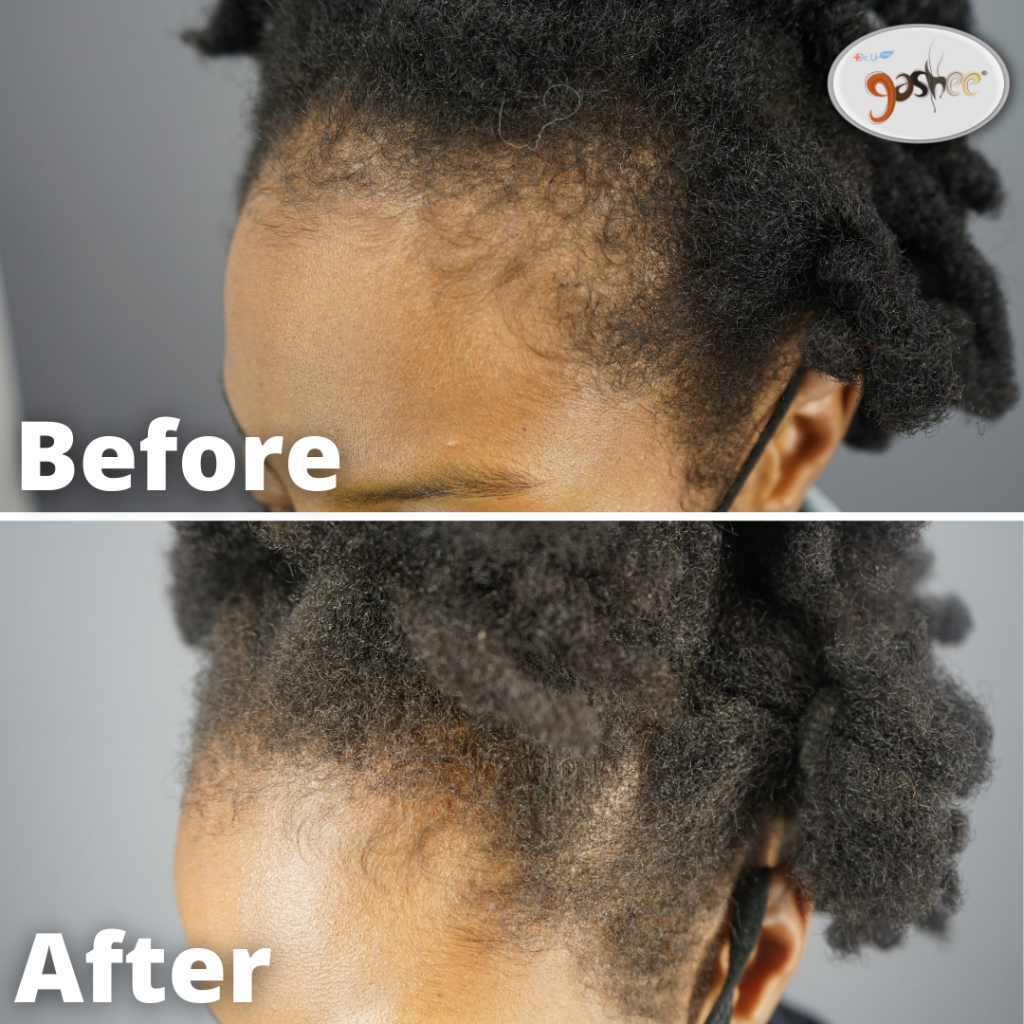 Before & After GASHEE Natural Hair Health Oral Supplements & Topical Lotion. The patient had previously reported a thinning front hairline. She used both GASHEE natural hair products twice daily. The picture shows 4 months of natural hair health results.*