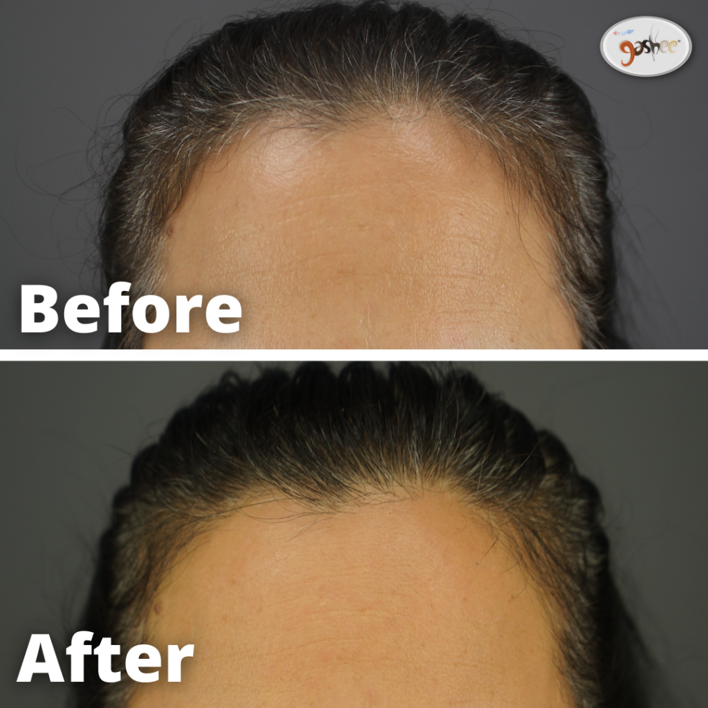 Dr.UGro GASHEE Before & After Results - Oral & Topical Lotion. 7 Months Natural Hair Health Results.*