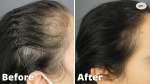 GASHEE Before and After Results - Oral & Topical Lotion Natural Hair Health Results.*