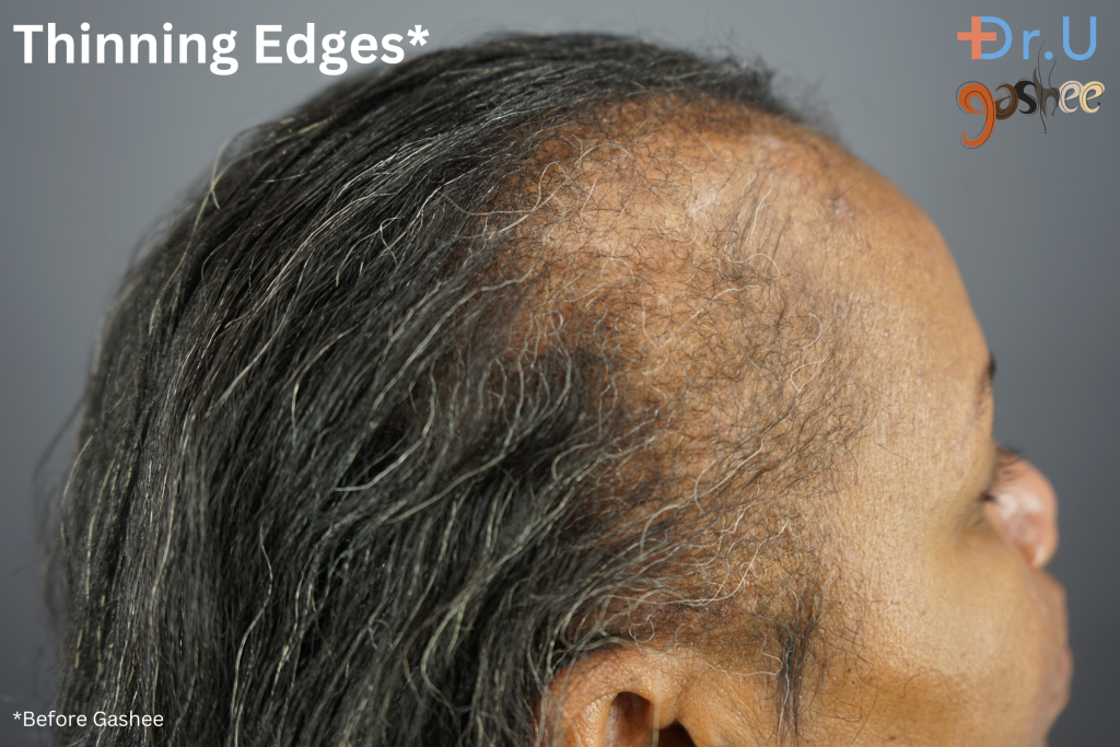 Felecia was struggling with thinning edges and hair loss prior to starting her Gashee treatment.